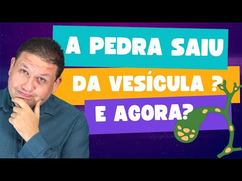 COLEDOCOLITÍASE !! Complicação de pedra na vesícula. O que fazer quando a pedra sai da vesícula.