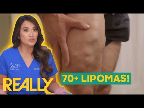 Dr. Lee Helps Patient With 70+ Lipomas | Dr. Pimple Popper