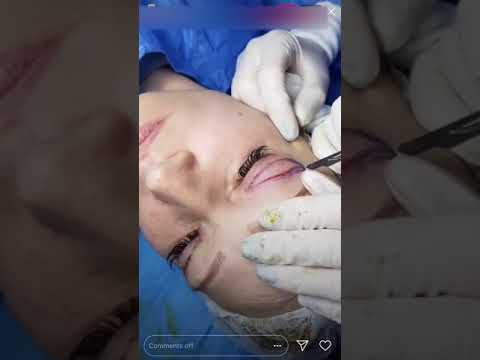 🔞 БЛЕФАРОПЛАСТИКА от курьера БРАУДЭ ! СЕМИНАР!
