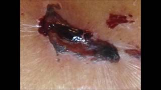 Morgellon Disease - My body was attacked by Reptillians