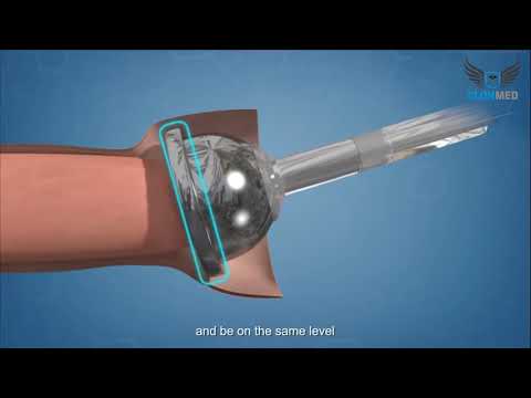 Disposable clonmed zsr circumcision khatna stapler for kids ...