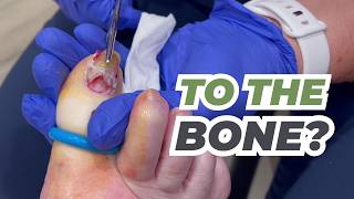 Ingrown to the BONE?