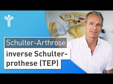 Shoulder arthrosis & tendon rupture – Treating shoulder pain with reverse shoulder arthroplasty (...