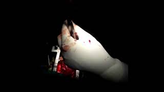 CORONARY AV FISTULA SURGICAL VIDEO