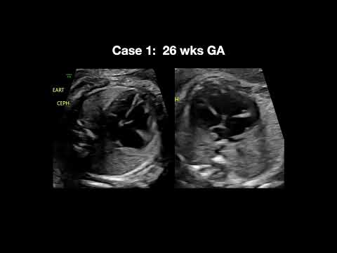 2023 Fetal Echocardiography: Normal and Abnormal Hearts - A Video CME Teaching Activity