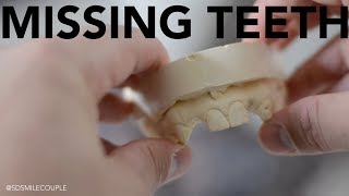 Replacing Teeth with Dental Implants!