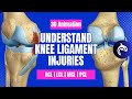 Understand Knee Ligament Injuries ACL PCL MCL LCL 3D Animation