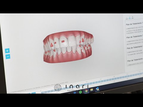 Clincheck Invisalign