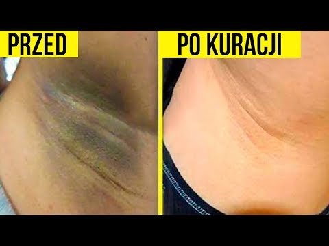 Witaminy dla włosów i paznokci, top 10 Wypadanie włosów i cholesterol