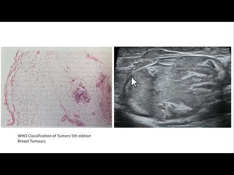 Cápsula fibrótica e desvio de vasos contribuindo no diagnóstico por imagem dos hamartomas