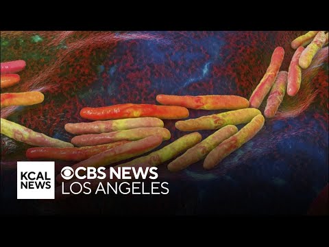 Tuberculosis Outbreak in Long Beach Raises Concerns