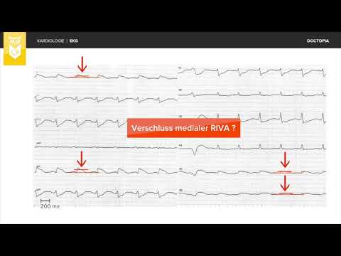 Akuter Herzinfarkt mit Hauptstammbild