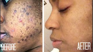 SKIN| How I Got Rid of Dark Scars (Hyperpigmentation) & Acne + GIVEAWAY!