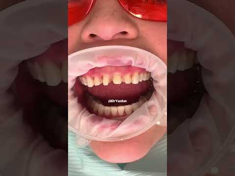Composite vs porcelain veneers | which is best for you? | Dr. Yazdan | veneers before and after