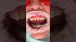 Composite vs porcelain veneers | which is best for you | Dr. Yazdan | veneers before and after