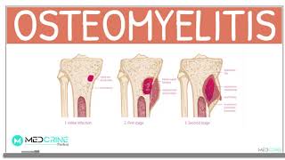 Osteomyelitis:  Classification, Causes, Pathophysiology, Signs and Symptoms, Diagnosis and Treatment