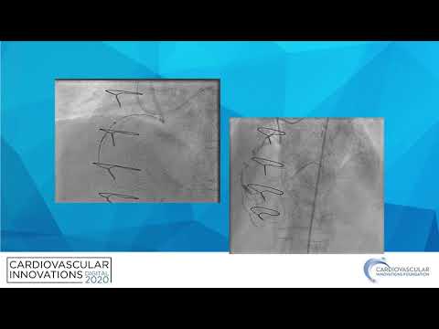 CTO PCI equipment update - Basem Elbarouni, MD