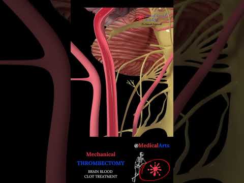 Mechanical Thrombectomy Stroke Animation #ischemicstroke