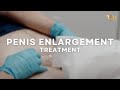 NON SURGICAL PENIS ENLARGEMENT With Dermal Fillers