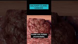 Download lagu Salivary Gland Cancer: Uncovering Head and Neck Cancer Types 🎗️🩺 mp3