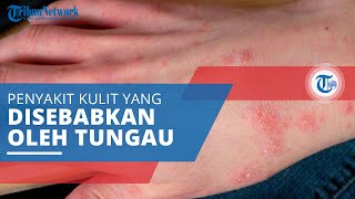 Kudis, Penyakit Kulit yang Disebabkan Infeksi Tungau atau Kutu, Ini Gejala dan Cara Mengobatinya