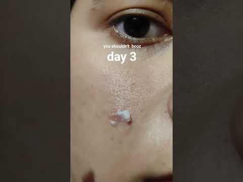 results 5 days of applying adapalene & benzoyl peroxide gel on cystic acne #acne #tretinoin #pimple