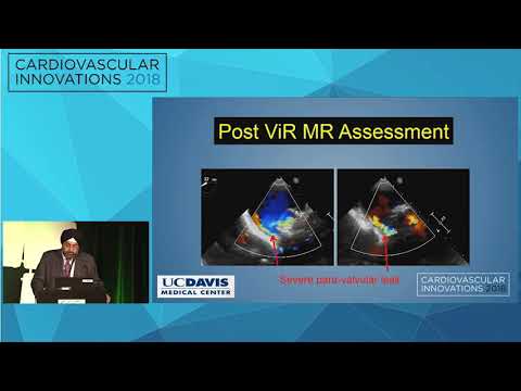 CVI2018 Session: Challenging transcatheter mitral valve replacement - Gagan Singh, MD