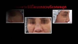 เลาะซิลิโคนเหลวที่จมูก