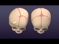 Craniosynostosis - Mayo Clinic 