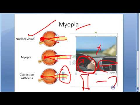 myopia recesszív gén hályog a szemen