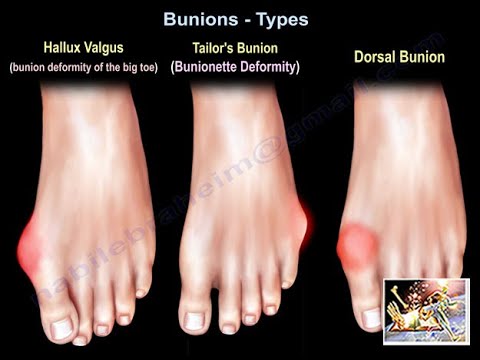 Bunions Types - Everything You Need To Know - Dr. Nabil Ebraheim