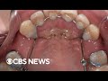 Lawsuit claims dental device damaged patients' teeth