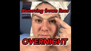 Removing Forehead Wrinkles Overnight