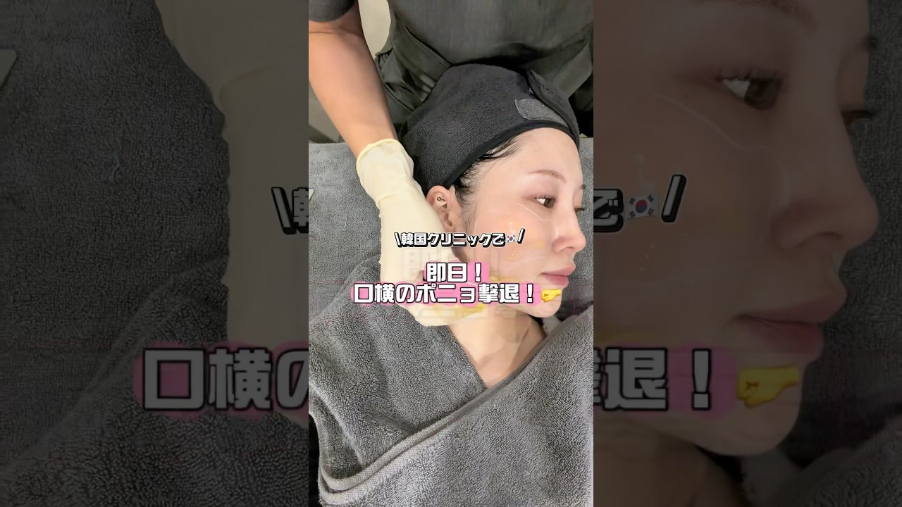 韓国クリニックで🇰🇷ダウンタイム0‼️小顔施術してきたよ！♡#pr #韓国美容