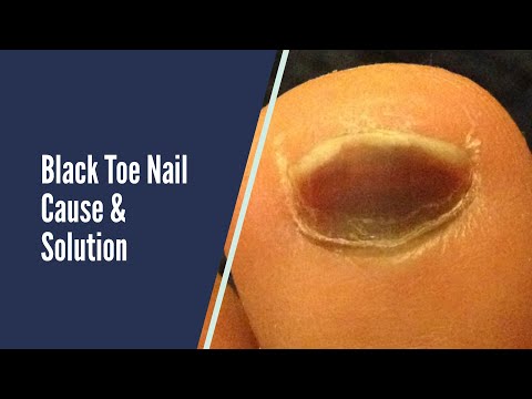 BLACK TOE NAILS - CAUSES AND SOLUTIONS