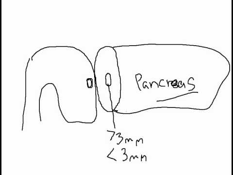 Whipple Procedure Pancreatic Anastomotic Techniques Part # 1