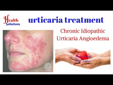 Urticaria treatment - Chronic Idiopathic Urticaria Angioedema Video