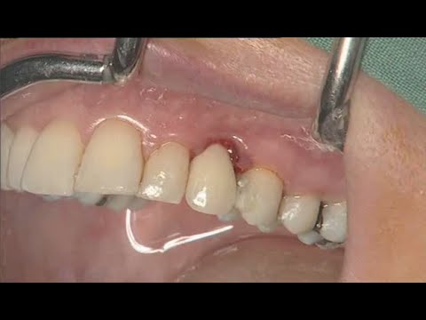 NobelActive clinical case: immediate implant placement - Eric Rompen