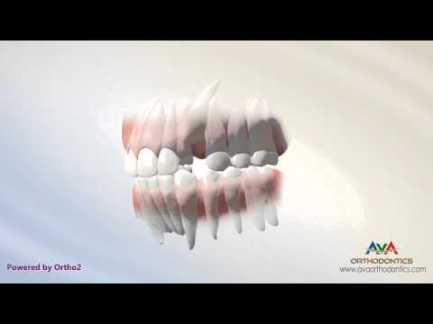 Orthodontic Space Management - Removing Primary Teeth