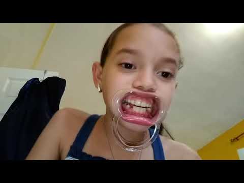 Mouth guard challenge