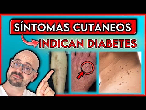 Estas Afecciones En La Piel Podrían Ser Un Indicativo De Diabetes