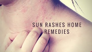 Home remedies for sunburn,sun blisters and rashes