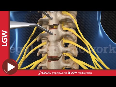 ACDF Cervical 3 Level Fusion surgery C3-4 C5-6 C6-7 3D animation
