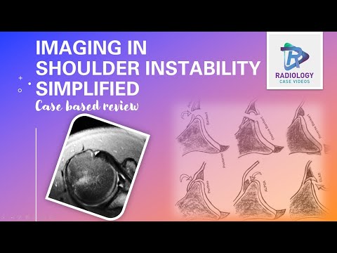 Imaging of shoulder instability simplified in 5 mins#Case based Review,