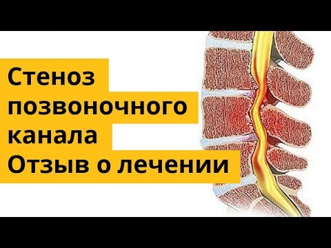 Лишний вес может быть причиной болей в спине Заложенность в ухе остеохондроз