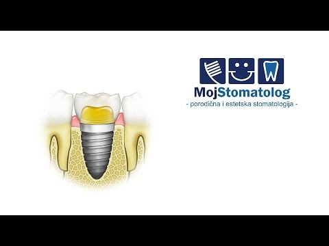 Izrada krunice na implantatu