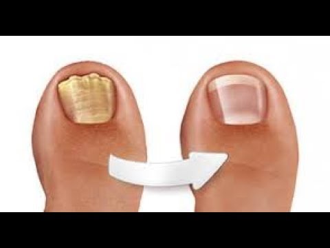 Comme Traiter Le Microorganisme Végétal Des Ongles Sur Les