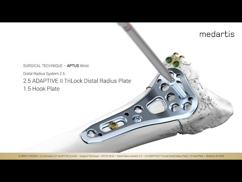 Surgical Technique Animation - 2.5 ADAPTIVE II TriLock Distal Radius Plate with the 1.5 Hook Plate