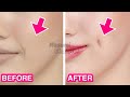 5mins Dimples Exercise! Simple Facial Exercises to get Dimples without Surgery