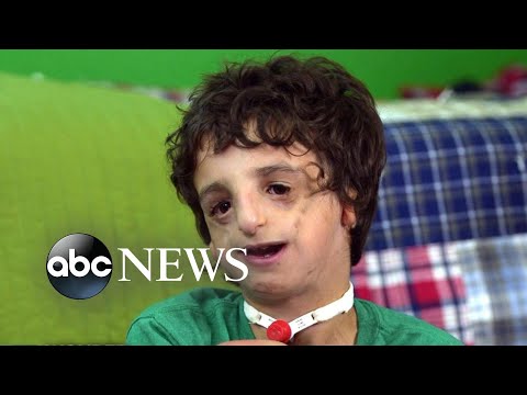 Boy living with Treacher Collins has 53 surgeries by age 11: 20/20 Part 2